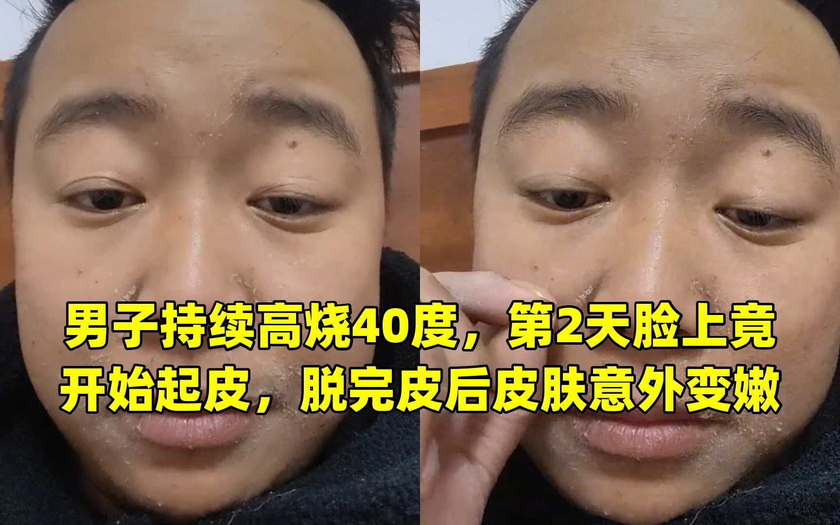 [图]男子持续高烧40度，第2天脸上竟开始起皮，脱完皮后皮肤意外变嫩