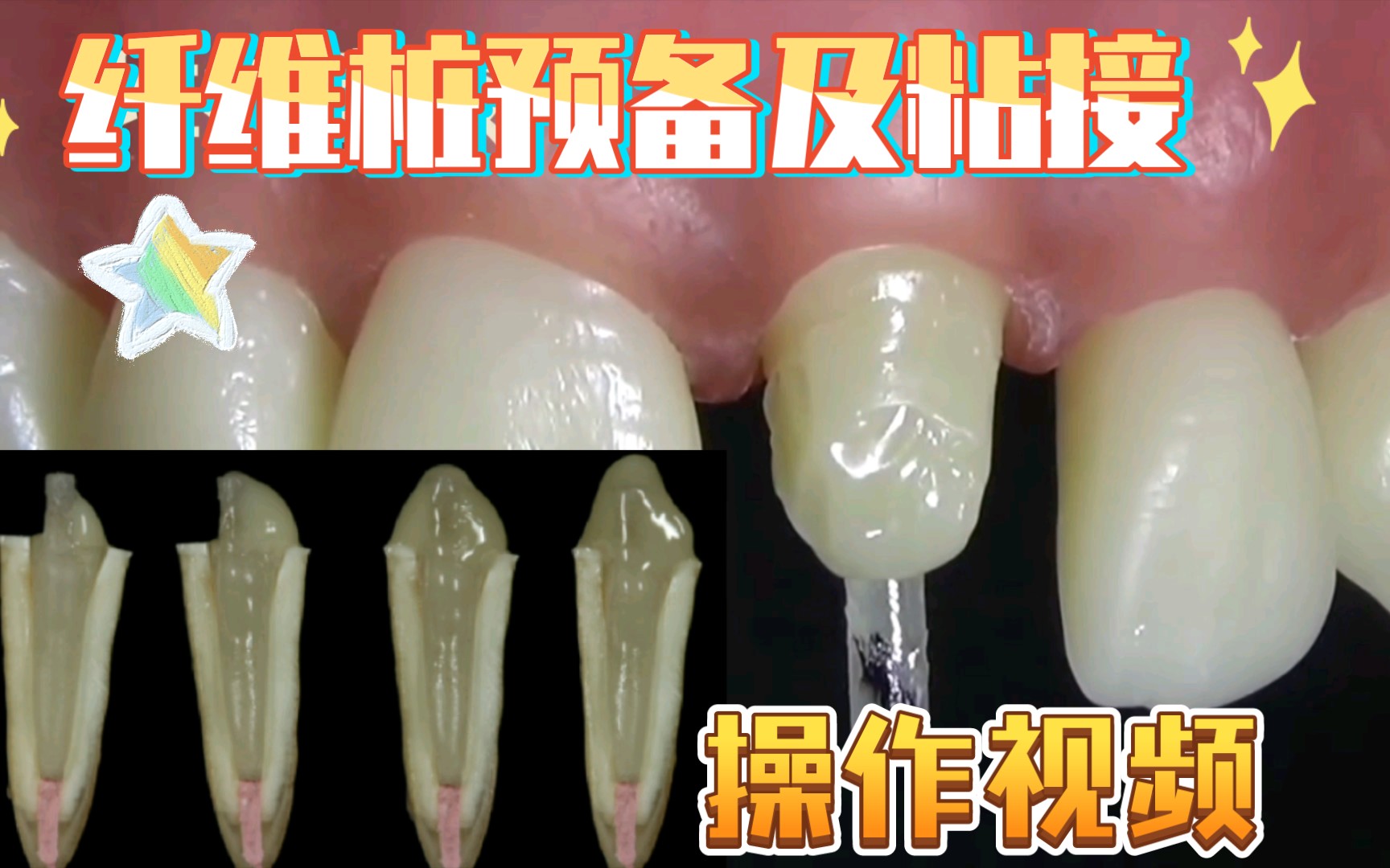【口腔技能】纤维桩预备及粘接流程操作视频