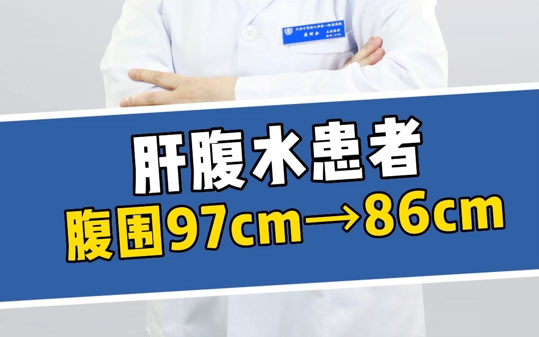 肝硬化腹水患者腹围97cm→86cm