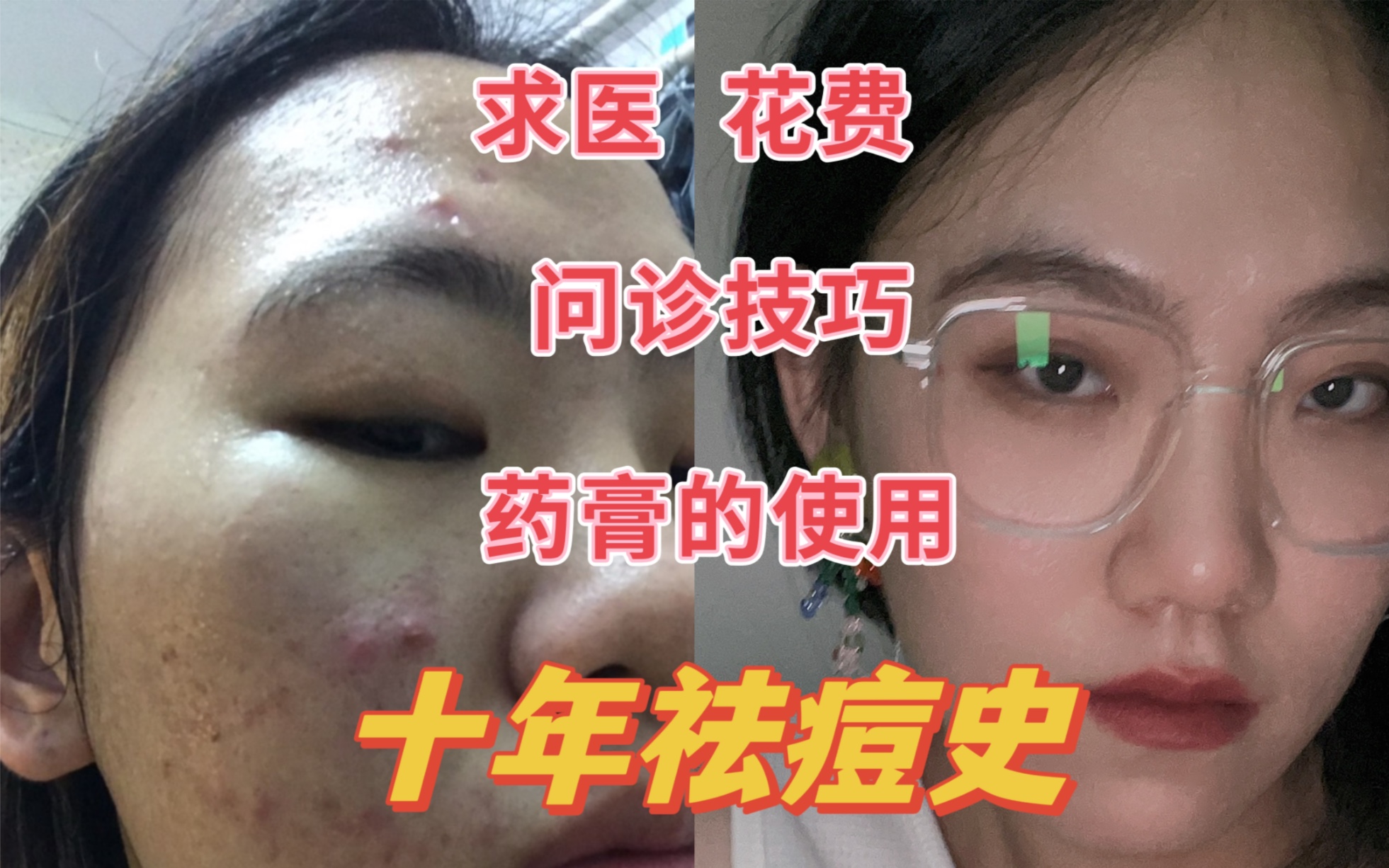 [图]祛痘经验｜关于求医问诊技巧；药膏的使用说明；治疗期间的具体花费