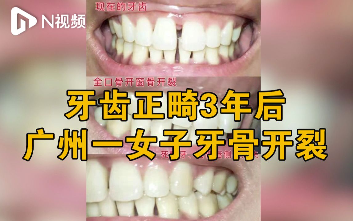 广州一女子正畸三年牙骨开裂,越秀卫健局:建议申请医疗事故鉴定哔哩哔哩bilibili