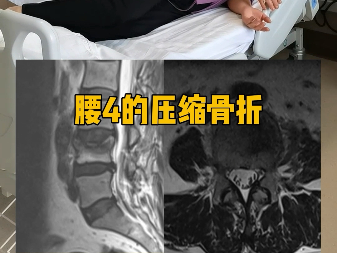 腰椎压缩性骨折复位固定#腰椎间盘突出 #椎间孔镜 #保盘手术