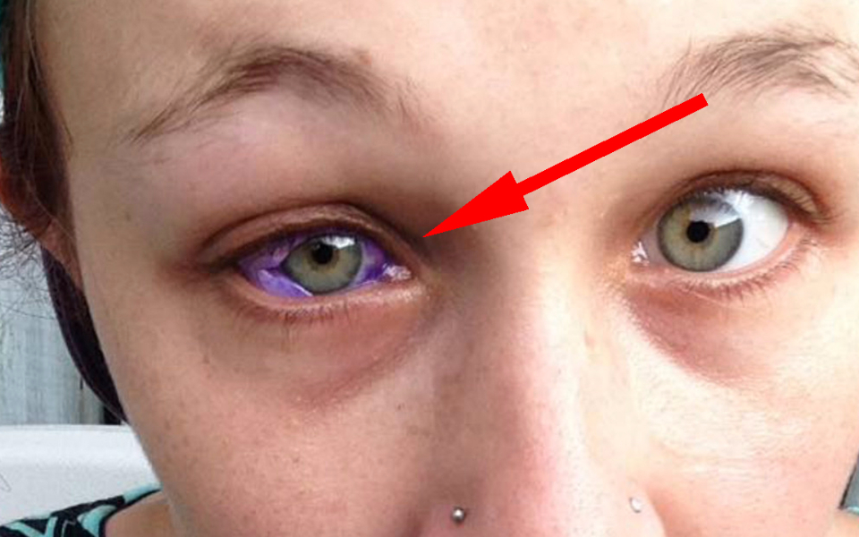 女子花50000美元想把眼睛变成紫色结果差点成瞎子