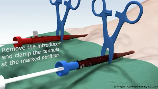 [图]ECMO 穿管视频