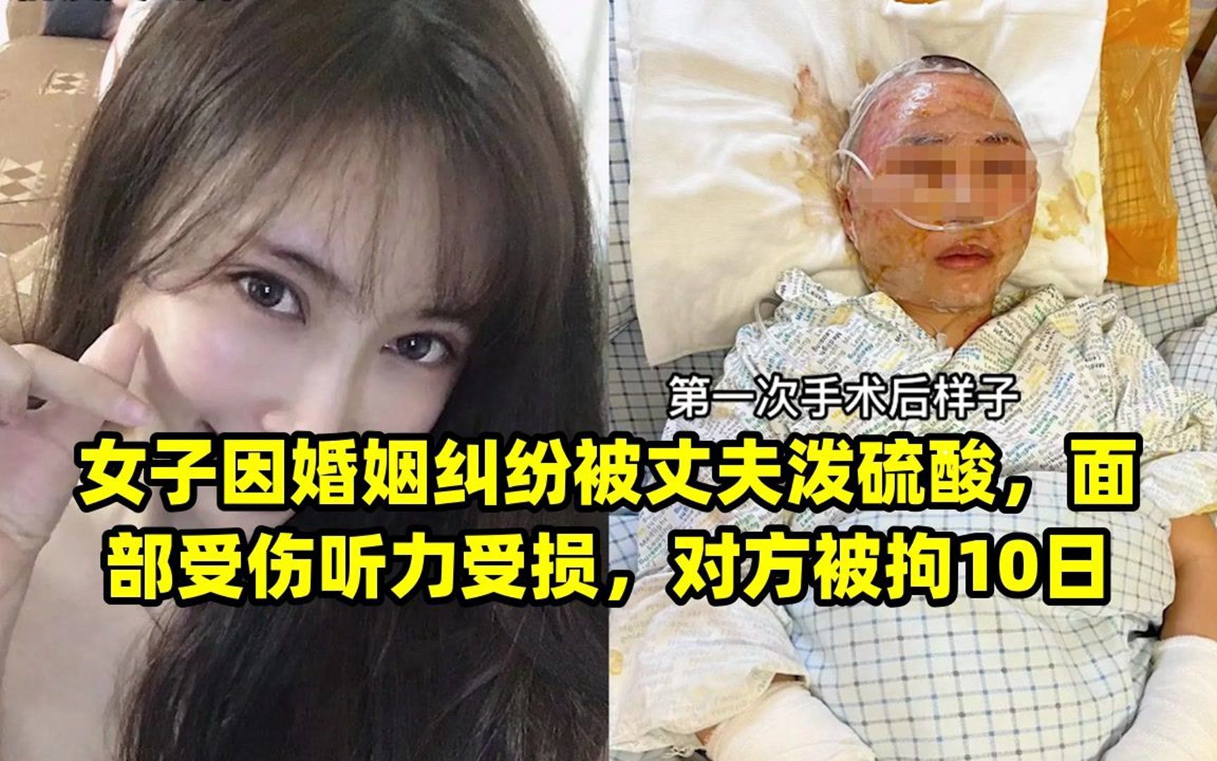 [图]女子因婚姻纠纷被丈夫泼硫酸，面部受伤听力受损，对方被拘10日