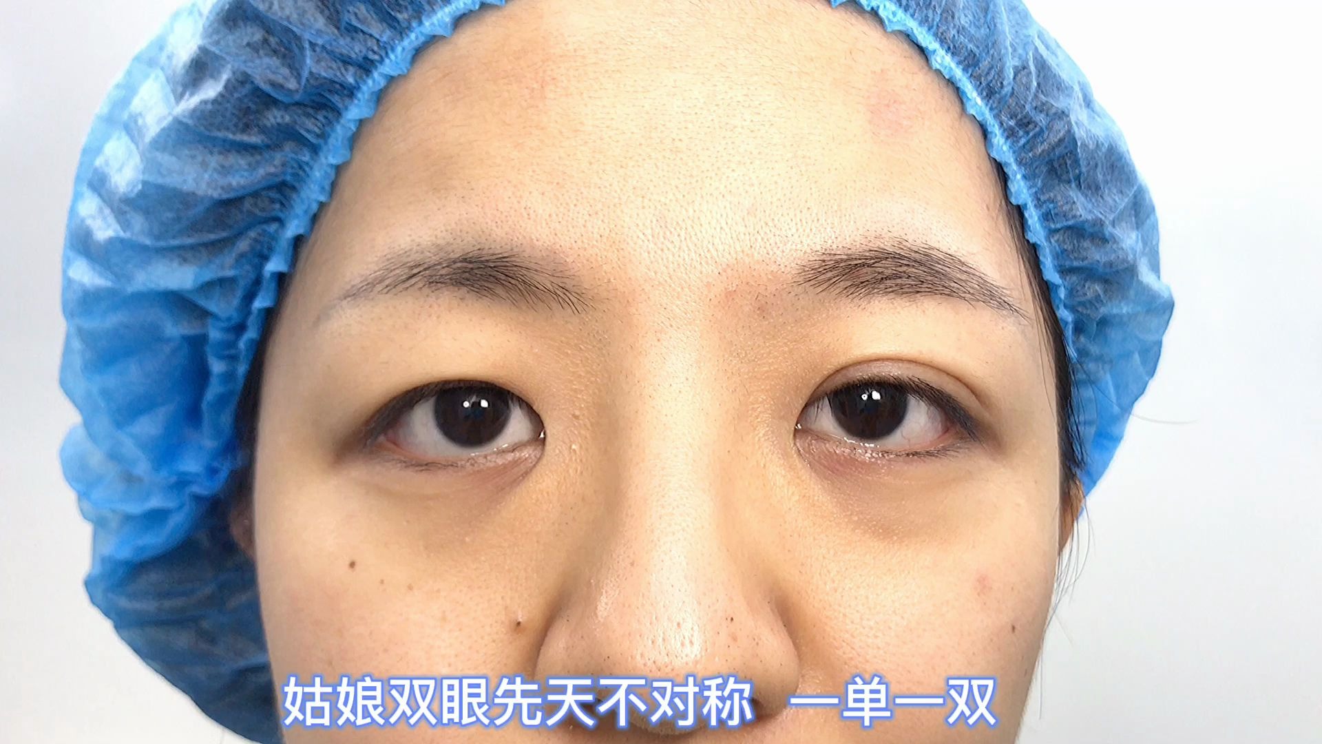 双眼皮一单一双的小伙伴还在纠结吗