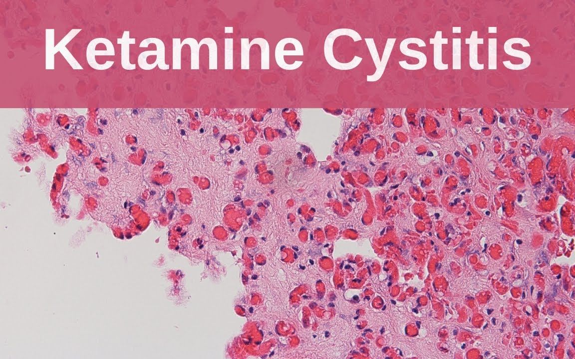 氯胺酮膀胱炎  病理学迷你教程哔哩哔哩bilibili