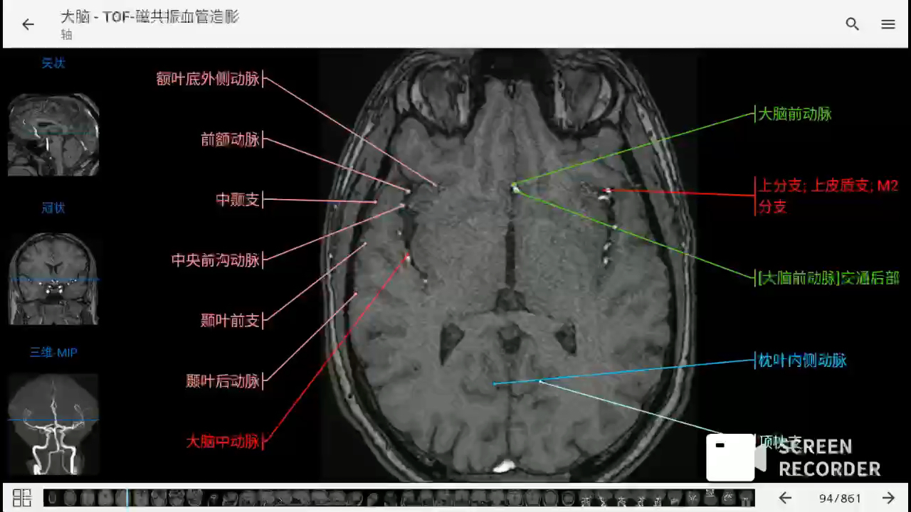 [图]影像解剖图谱神器 医学影像学必备 e-anatomy中文最新版 脑血管MRI