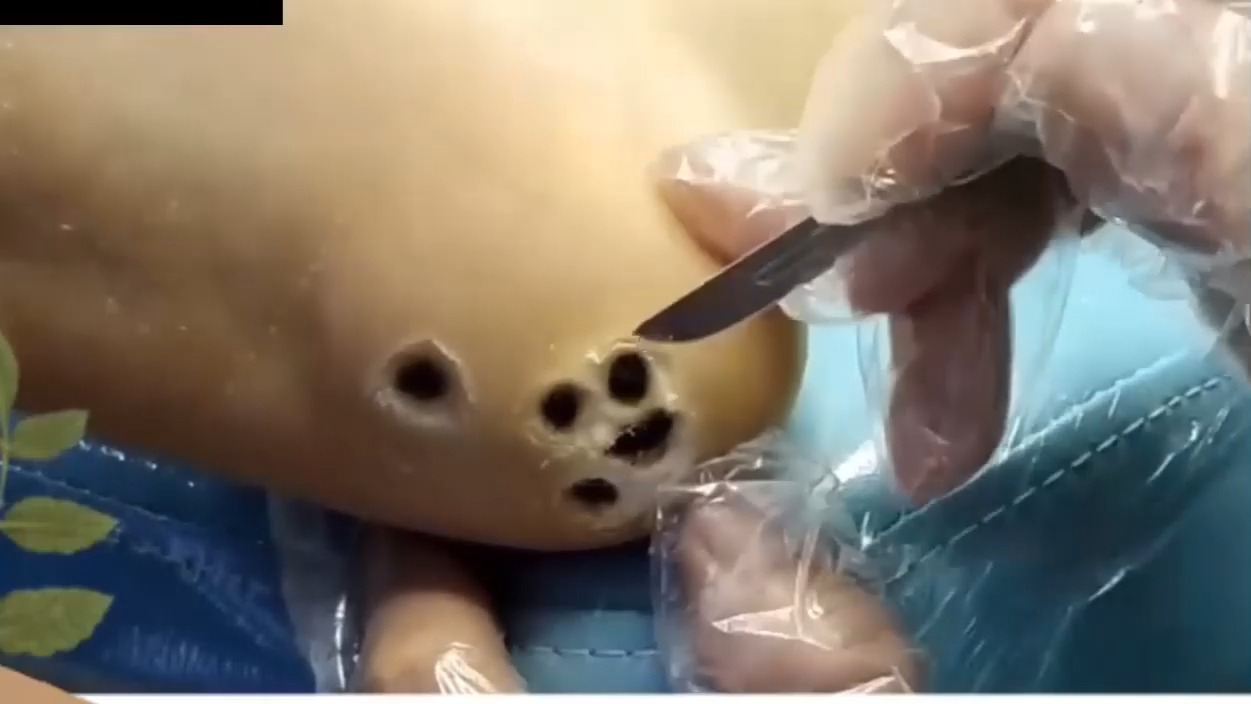 把鸡眼儿连根拔起 !