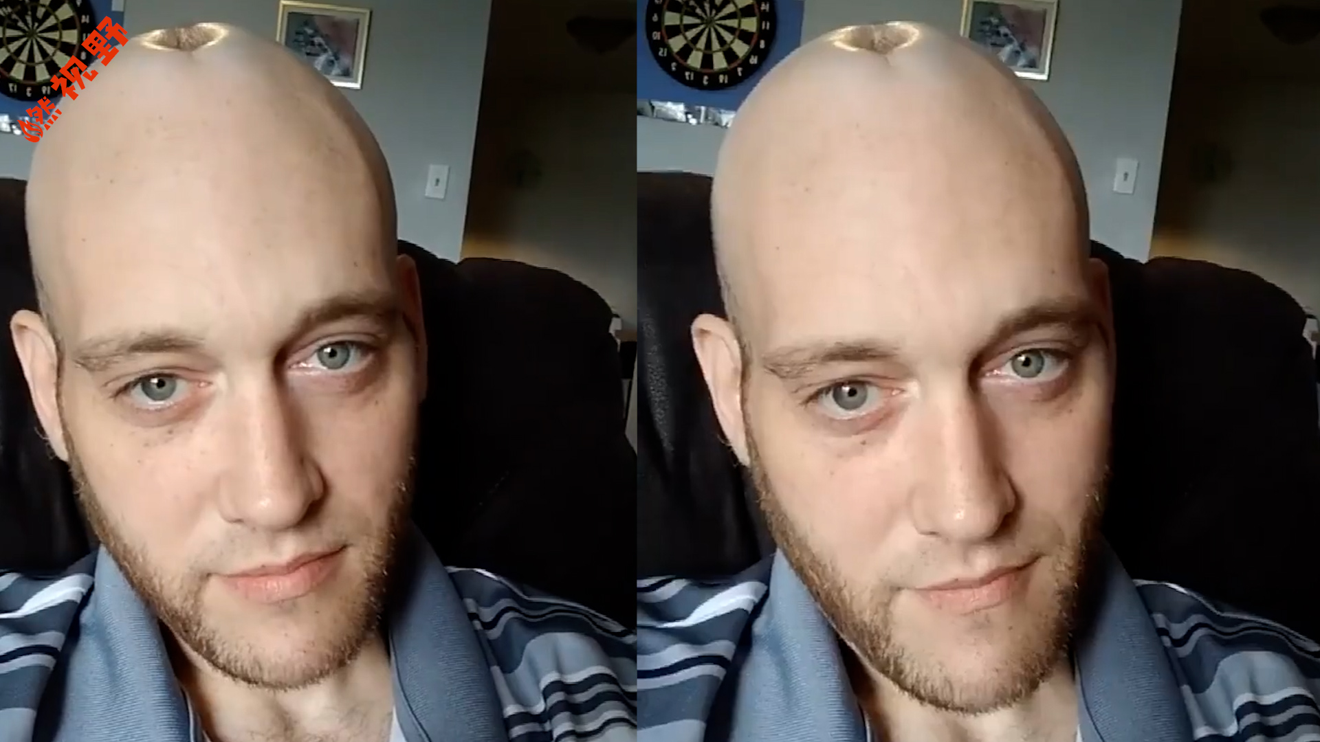 国外小哥脑袋顶上有个洞,公开求嘲讽,网友们的脑洞花样百出!