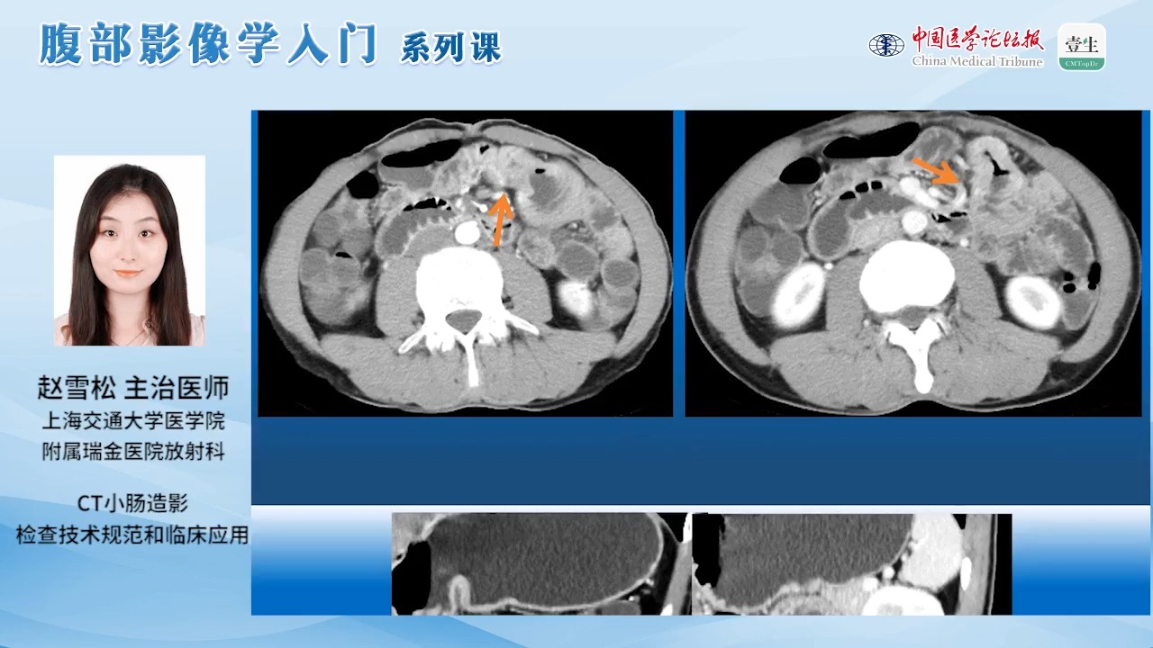 ct小肠造影检查技术规范和临床应用