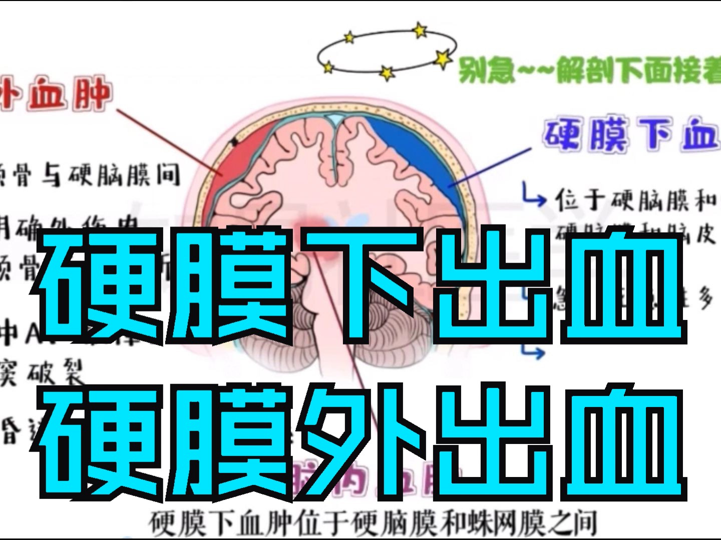 医学带背 硬膜外出血 vs 硬膜下出血 vs 脑出血