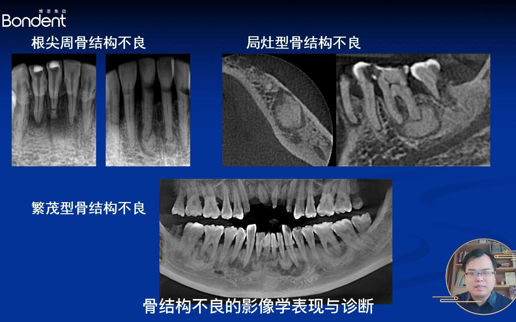 牙骨质结构不良图片