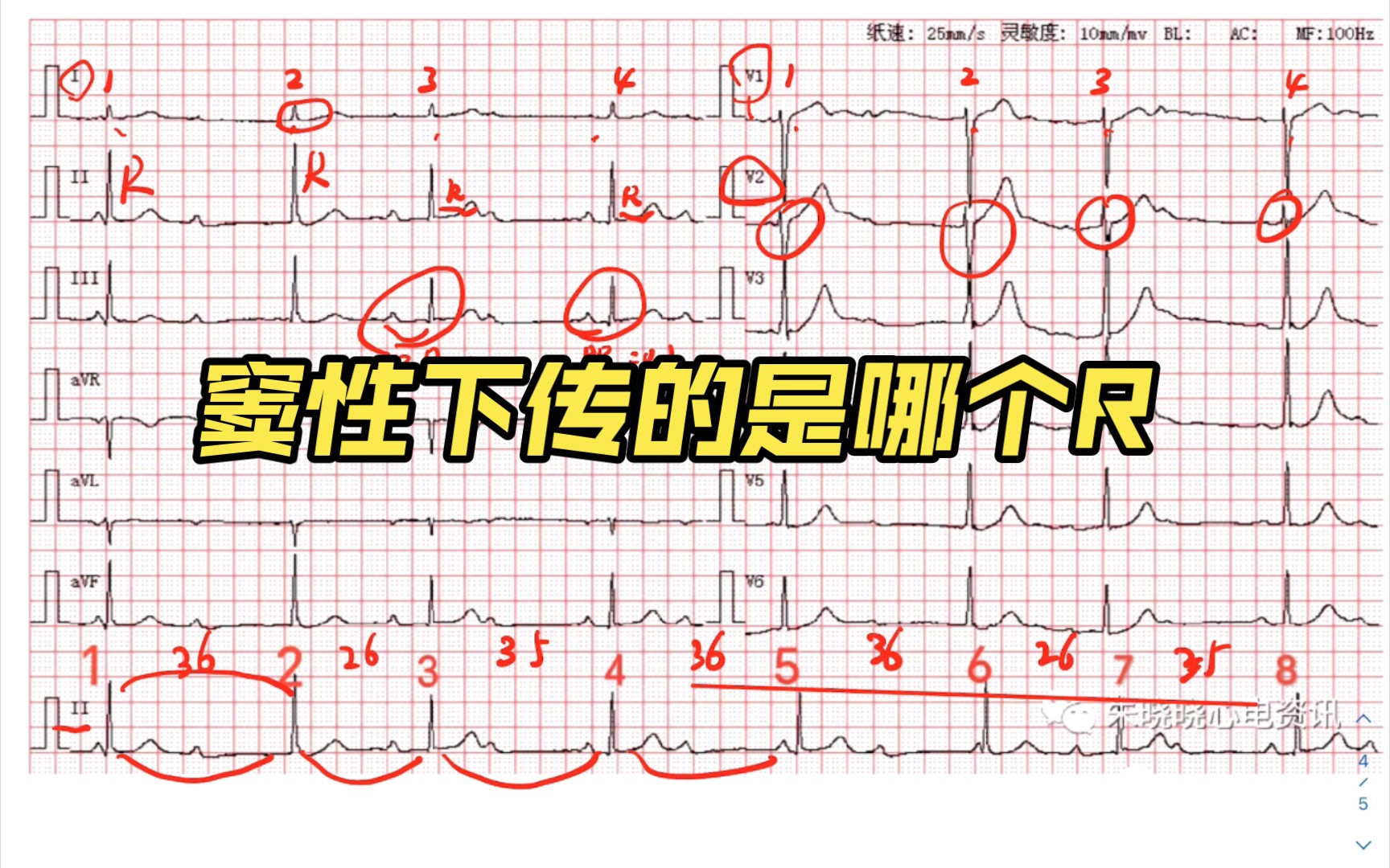 竇性心律,交界區/交接性逸搏,高度房室傳導阻滯,r波電交替