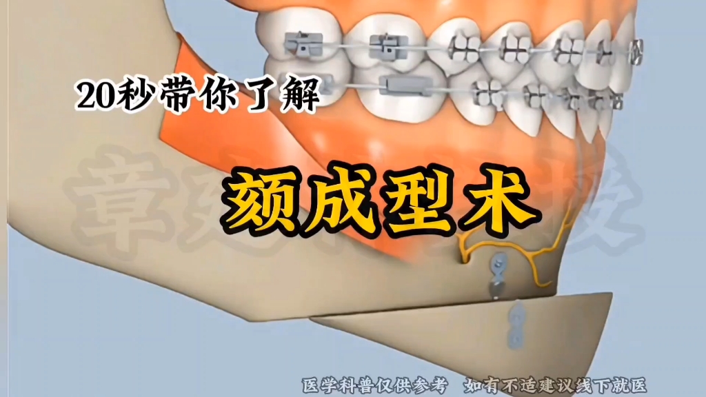 20秒带你了解颏成型术!