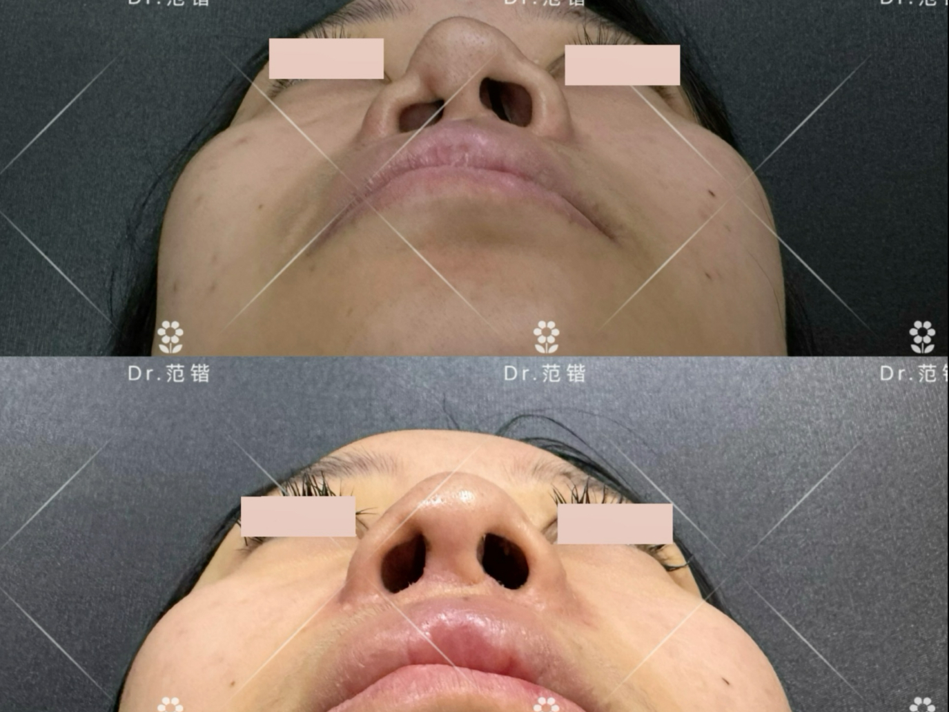 唇裂鼻畸形二期修复