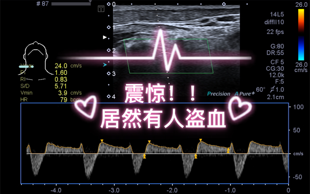 超声学习——盗亦有道之《锁骨下动脉盗血》哔哩哔哩bilibili