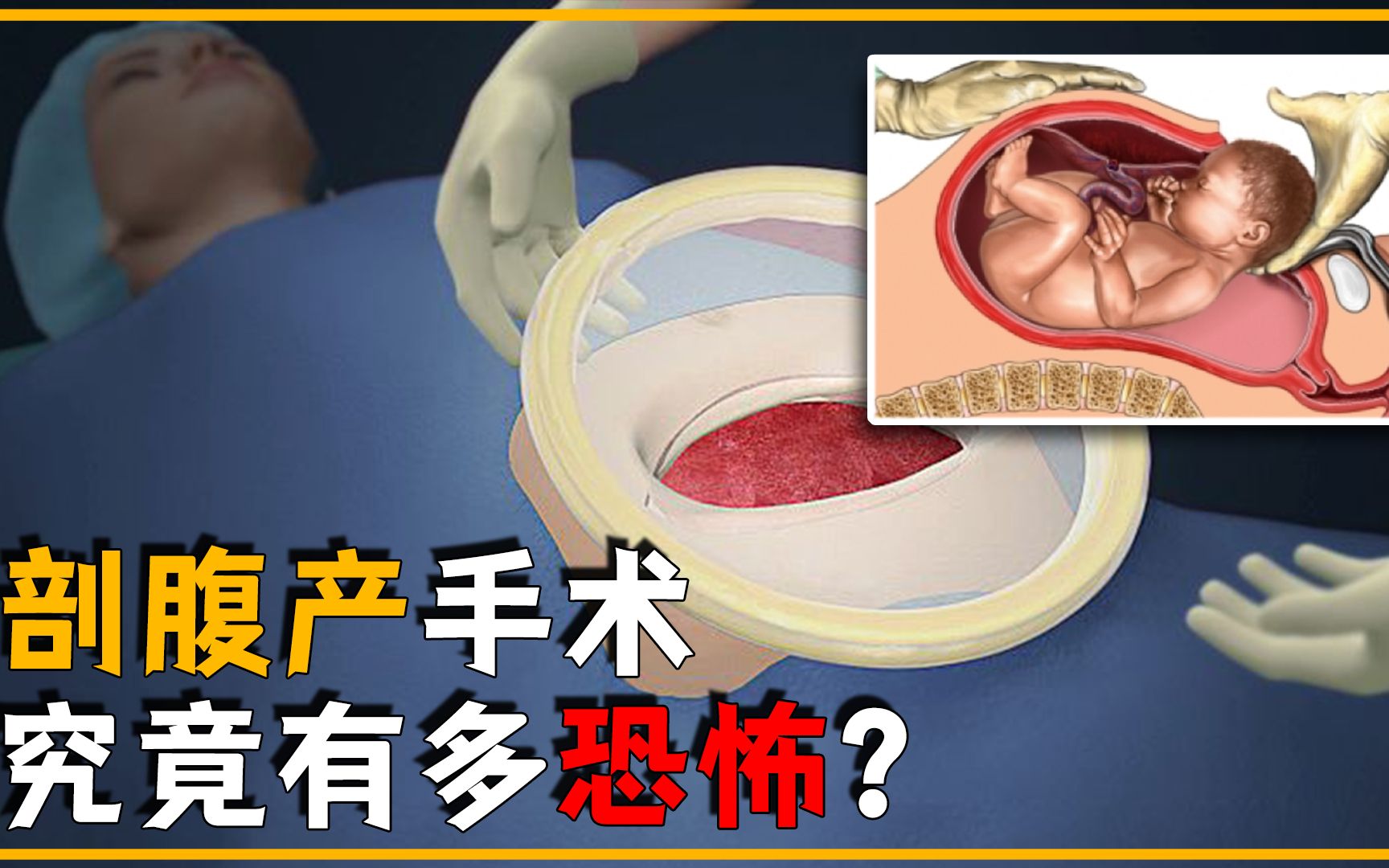 剖腹产手术究竟有多恐怖?揭秘手术全过程,看完你还跟妈妈顶嘴吗哔哩哔哩bilibili