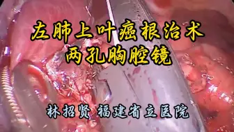 后入路法处理血管（两孔胸腔镜）左肺上叶癌根治术 详细解说版 林招贤教授供稿
