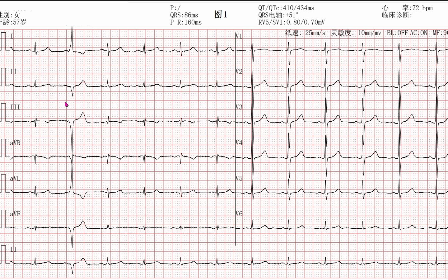 心室预激心电图图片