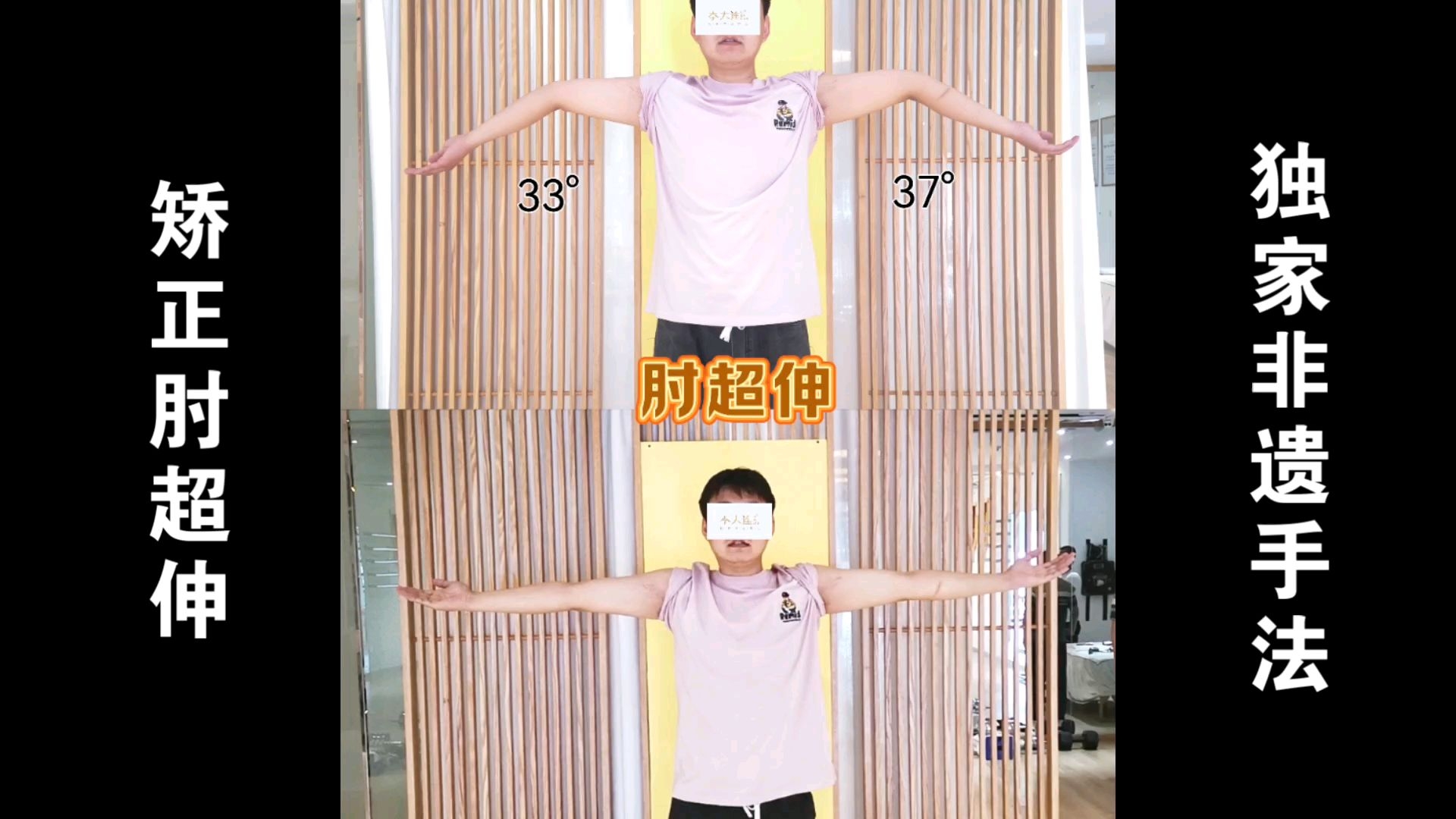 独家非遗手法矫正肘超伸连续十天,肘超伸从左手37°右手33°恢复到0