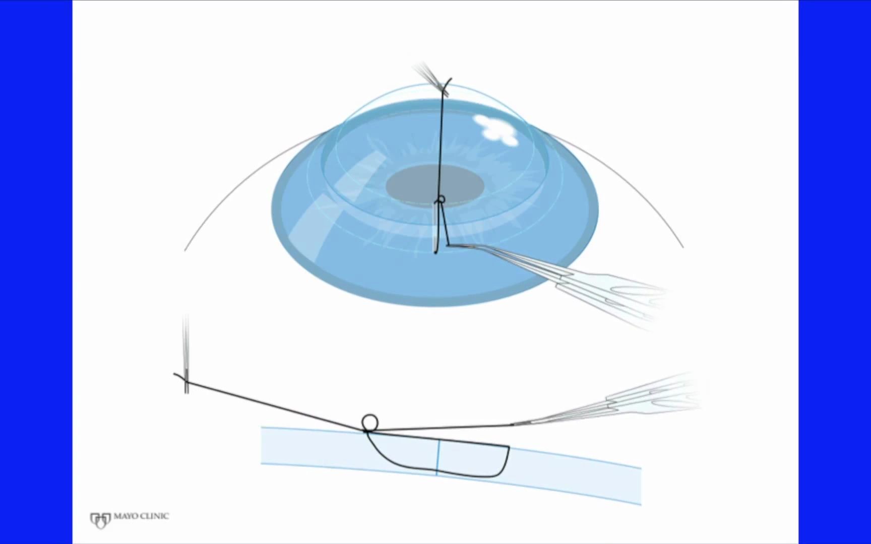 角膜缝合保姆级教学 part_5