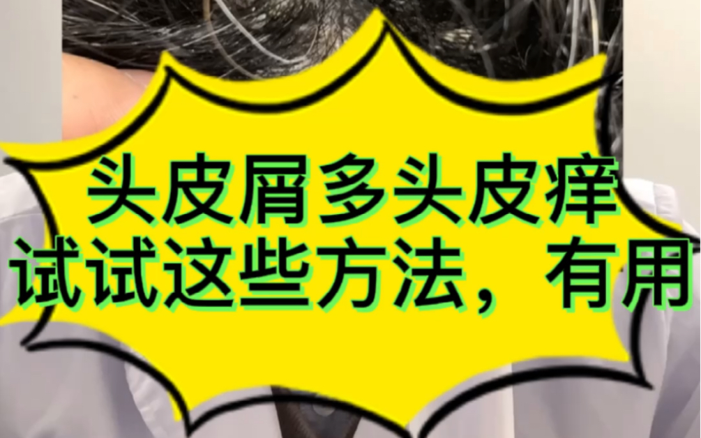 头皮屑多头皮痒,这是脂溢性皮炎,试试这些方法,也许有用哔哩哔哩bilibili