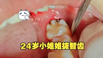 Descargar video: 24岁小姐姐拔智齿，看完整个人都舒畅了~超解压