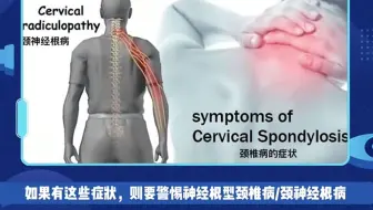 颈椎压迫神经时该如何进行自我复健 医路向前行by林峻生医师 哔哩哔哩 Bilibili