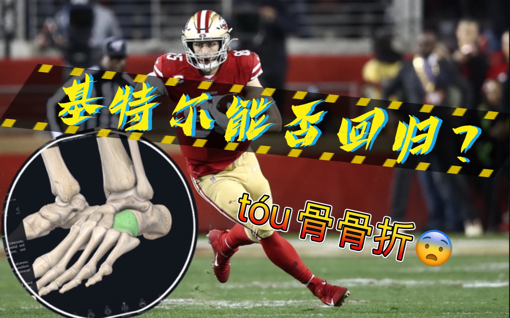 骰骨骨折是什么?该如何预防?Fantasy能选Kittle吗?哔哩哔哩bilibili