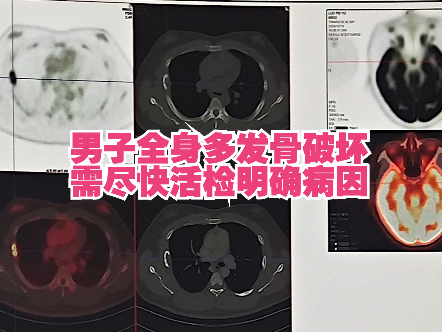 男子外院PETCT检查提示全身多发骨破坏,肺部实性结节,考虑肿瘤性病变,需要活检明确.哔哩哔哩bilibili