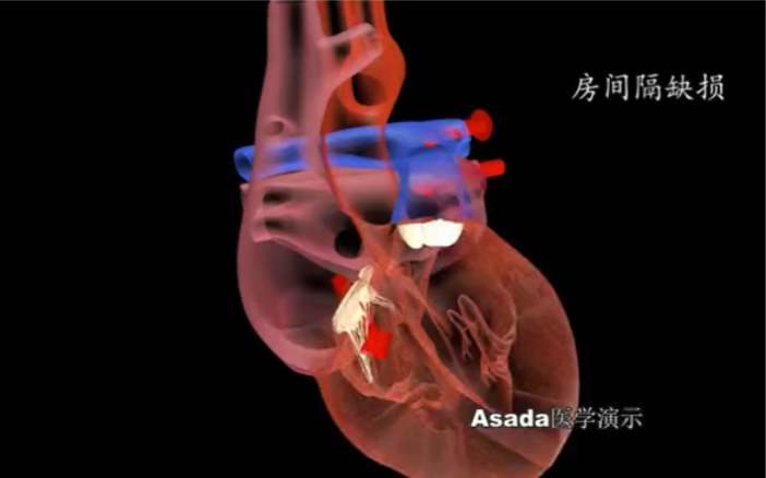 3d医学演示，4种先天性心脏病