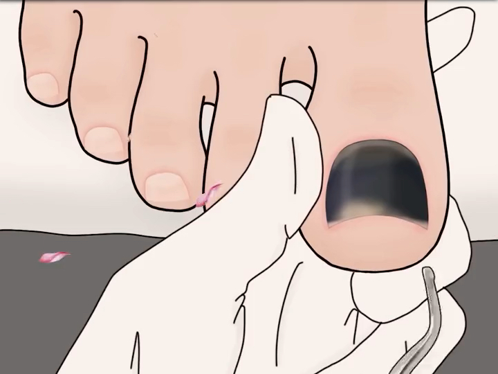 解压动画,帮校花女神修理灰指甲