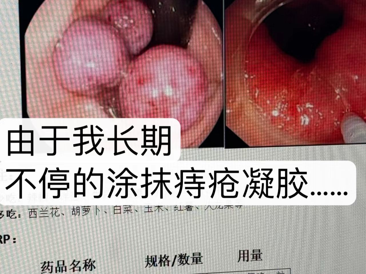 外痔的肉球照片图片