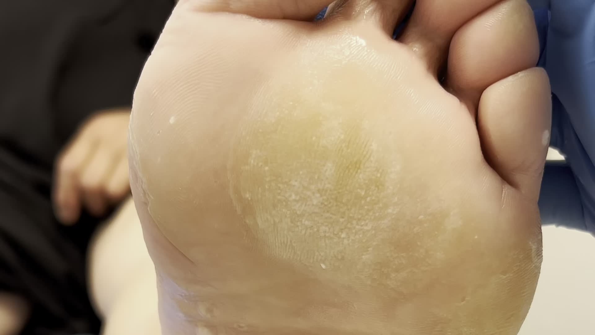 厚厚的脚皮