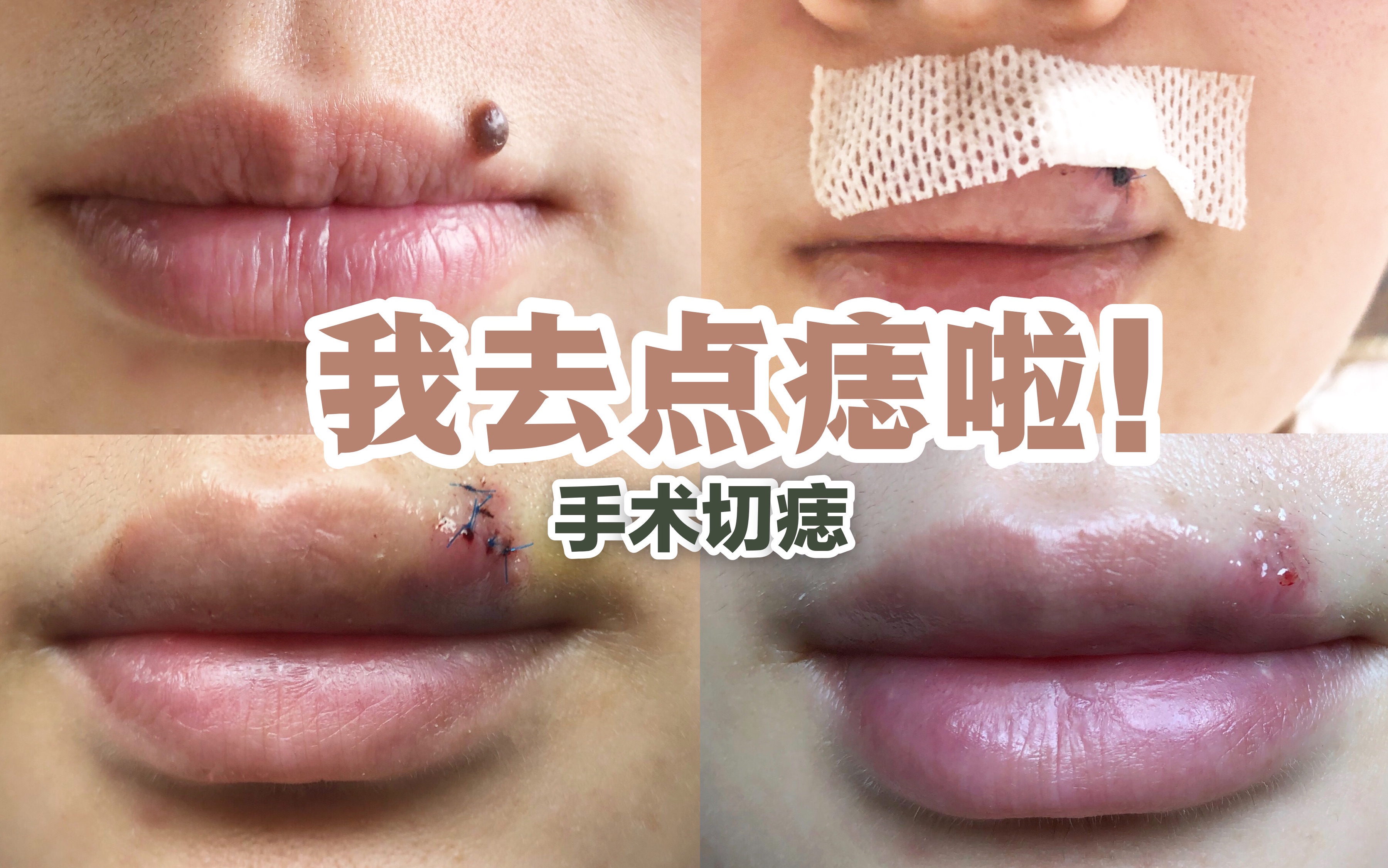 终于把长了近20年的痣点掉啦!