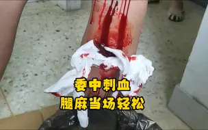 Tải video: 委中刺血！腿麻当场轻松！