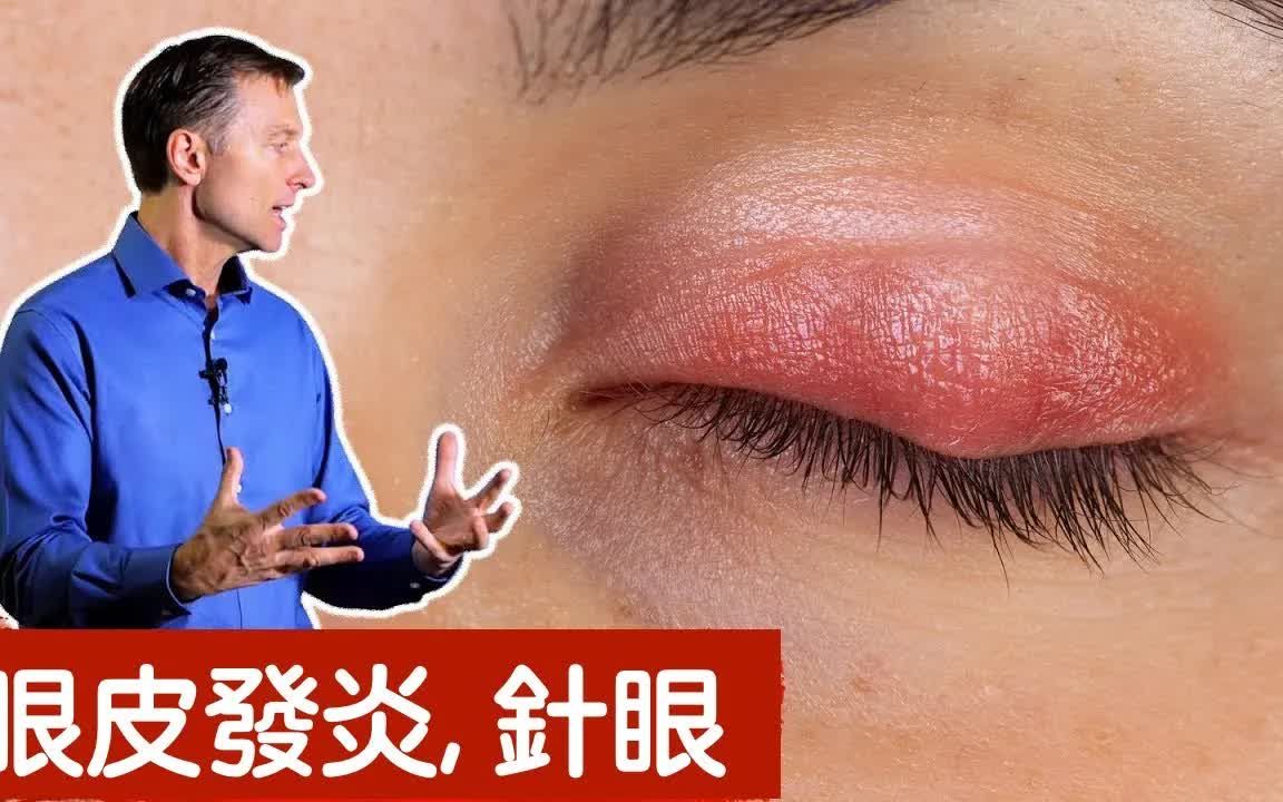 [图]眼皮發炎,針眼的自然療法,柏格醫生 dr berg