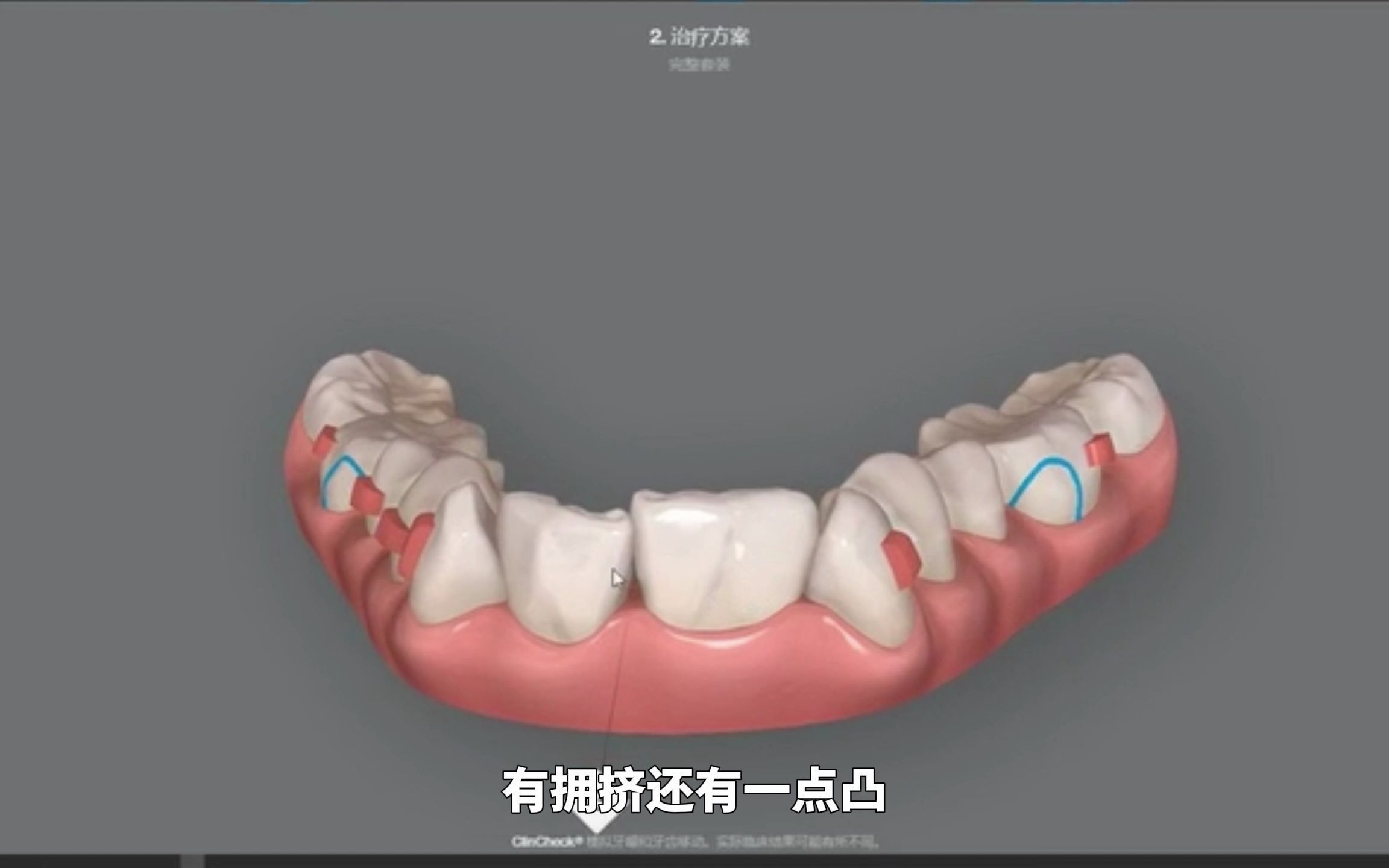 一位有假牙+融合牙的隐适美牙齿矫正全过程哔哩哔哩bilibili