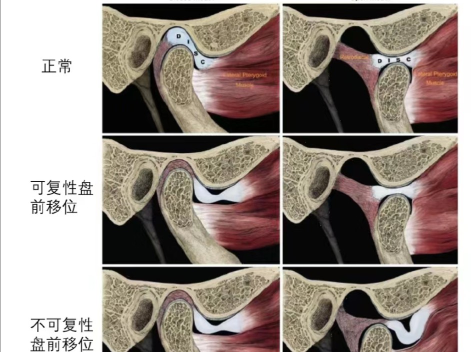 颞下颌关节解剖图手绘图片