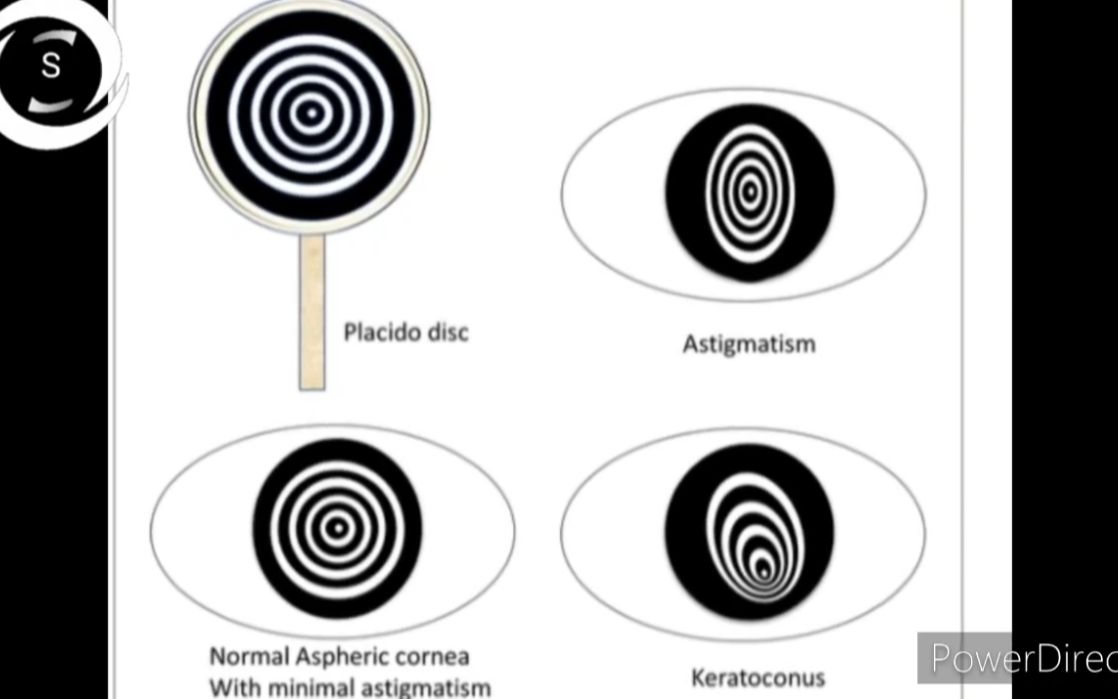 【中英双字】【Placido盘】【角膜地形图/角膜曲率】Placido disc CT series 1哔哩哔哩bilibili