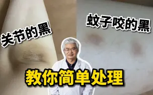 Descargar video: 【科普】这两种影响颜值的黑印子，皮肤科医生教你简单处理！