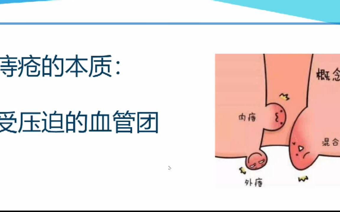 痔疮的原因,得了痔疮如何坐浴哔哩哔哩bilibili