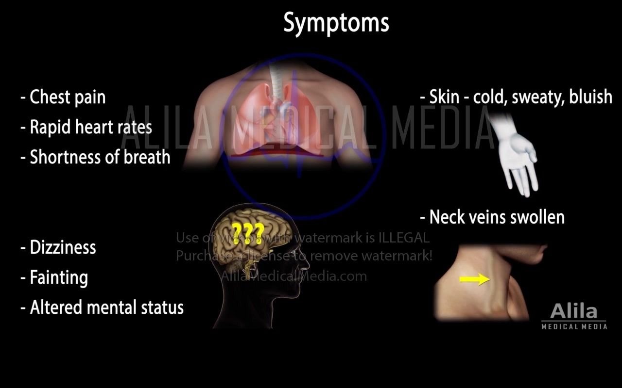 【Alila Medical Media】26. 心包填塞哔哩哔哩bilibili