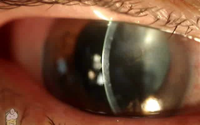 角膜裂伤Seidel征阳性cornealaceration哔哩哔哩bilibili