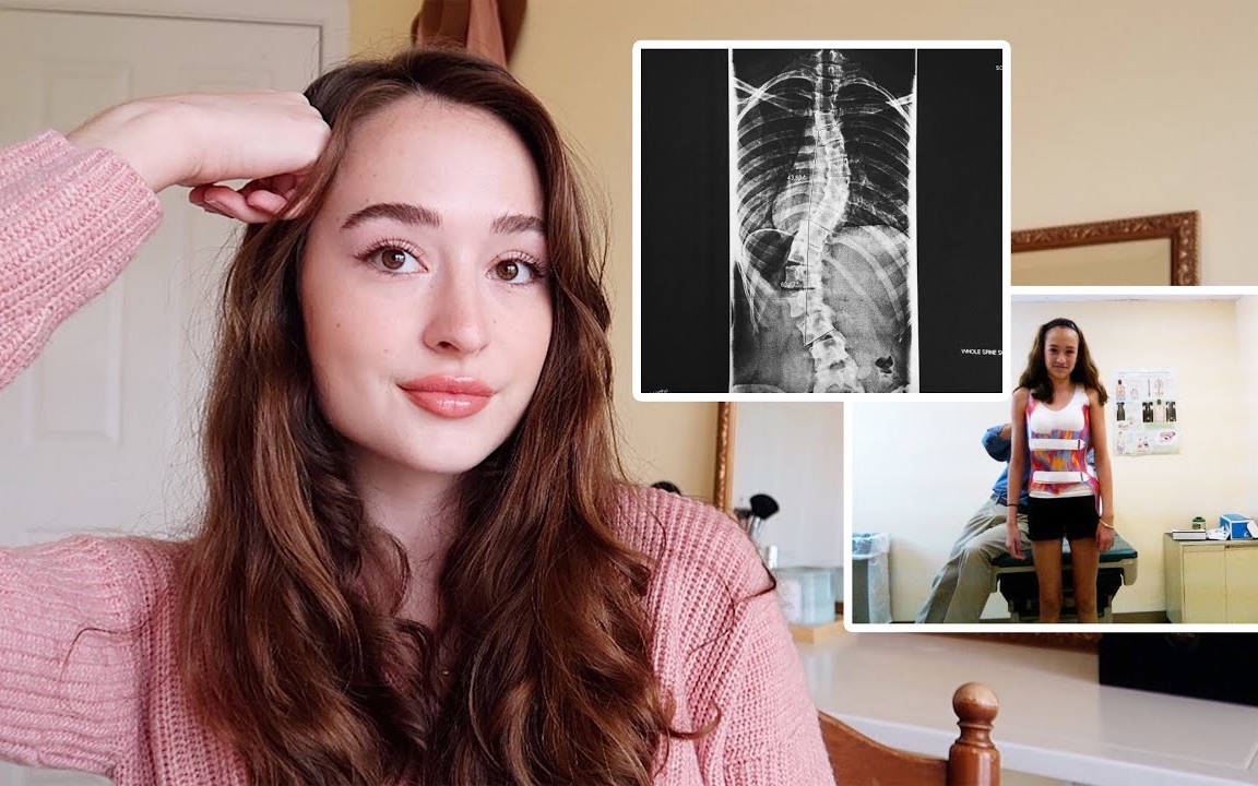 【sincerely, sarah c】聊聊我的脊柱侧弯|my journey with severe