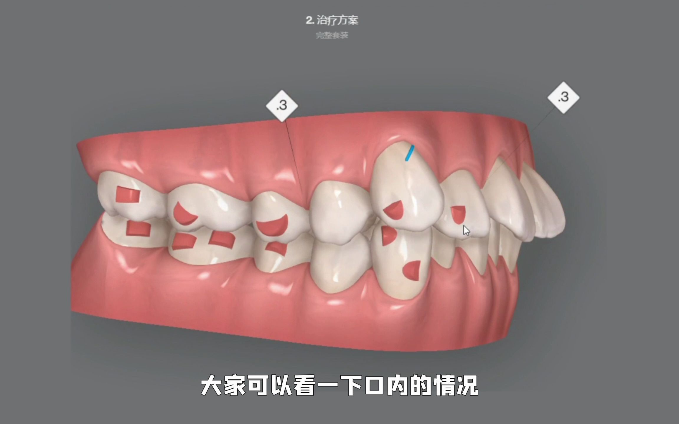 龅牙、嘴凸的牙齿矫正方案设计哔哩哔哩bilibili