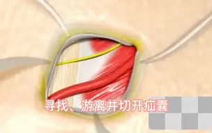 下载视频: 腹股沟疝修补手术动画演示，值得收藏！