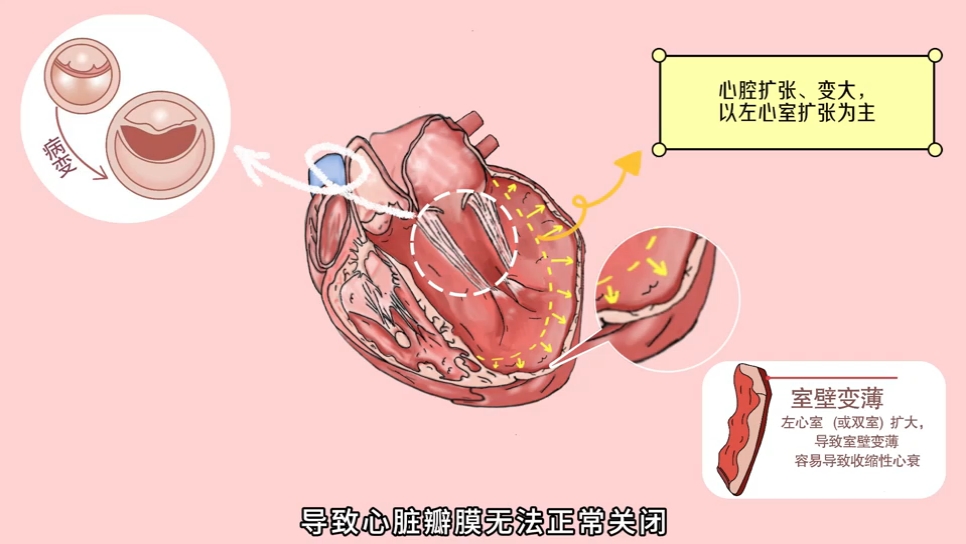 "心大"也是病——扩张型心肌病