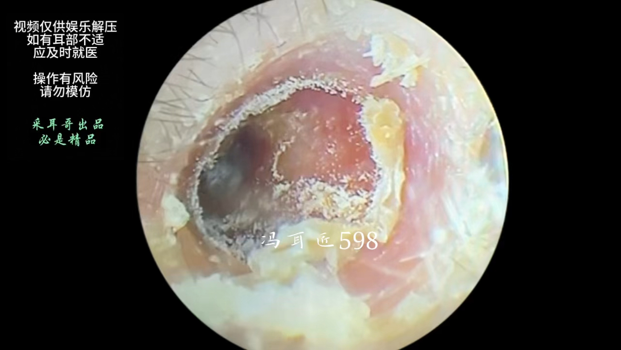 耳道发霉干片,鼓膜上的耵聍片哔哩哔哩bilibili